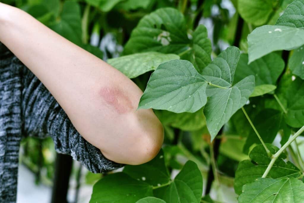 de uitslag wordt veroorzaakt door twee planten